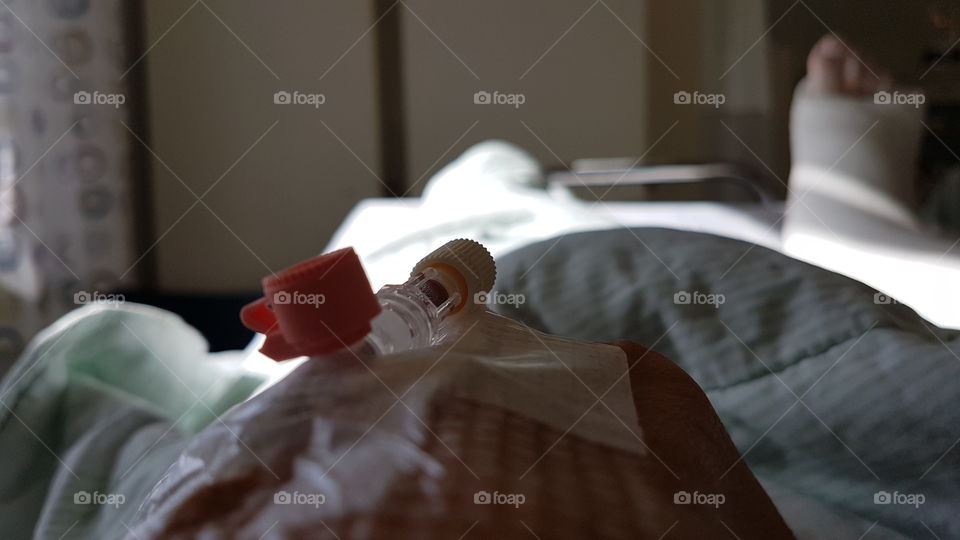 In hospital bed after foot surgery - i sjukhussäng efter fotoperation 