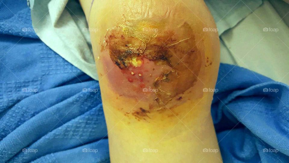 Flesh Eating Virus (MRSA)  consumes knee