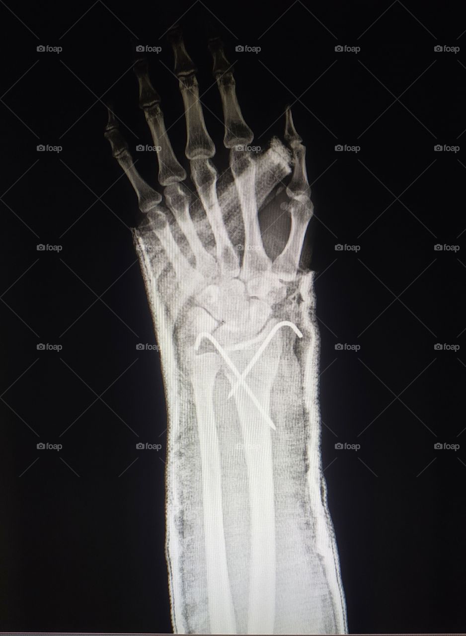 Post operative implant Xray of Wrist Ap view