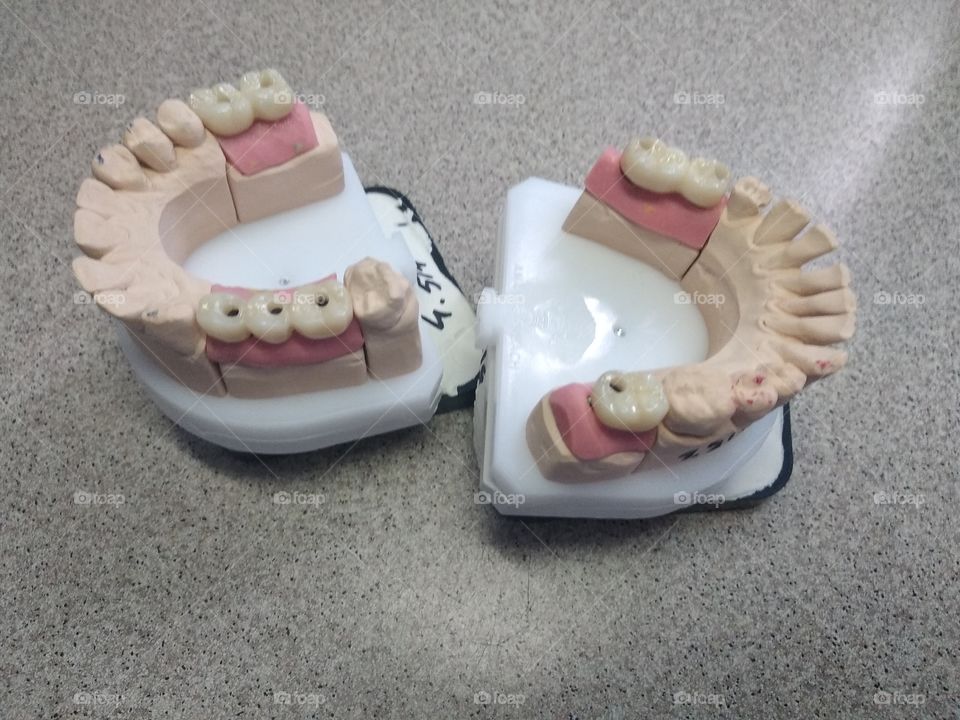 Dentures ceramic