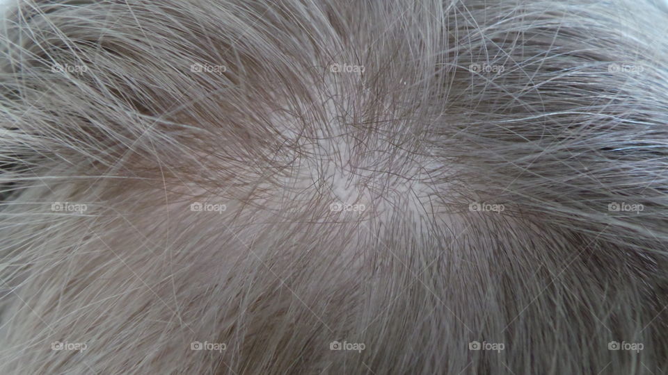 child's scalp