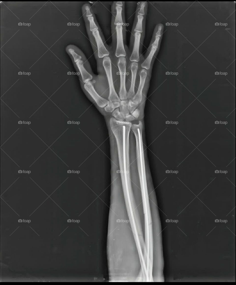 implant xray of forearm injury