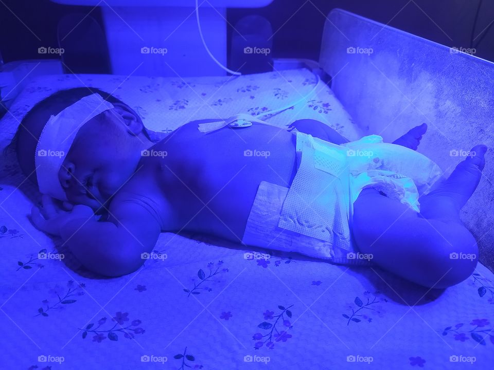 PHOTOTHERAPY Treatment for jaundice disease to NICU baby in Multispeciality hospitals