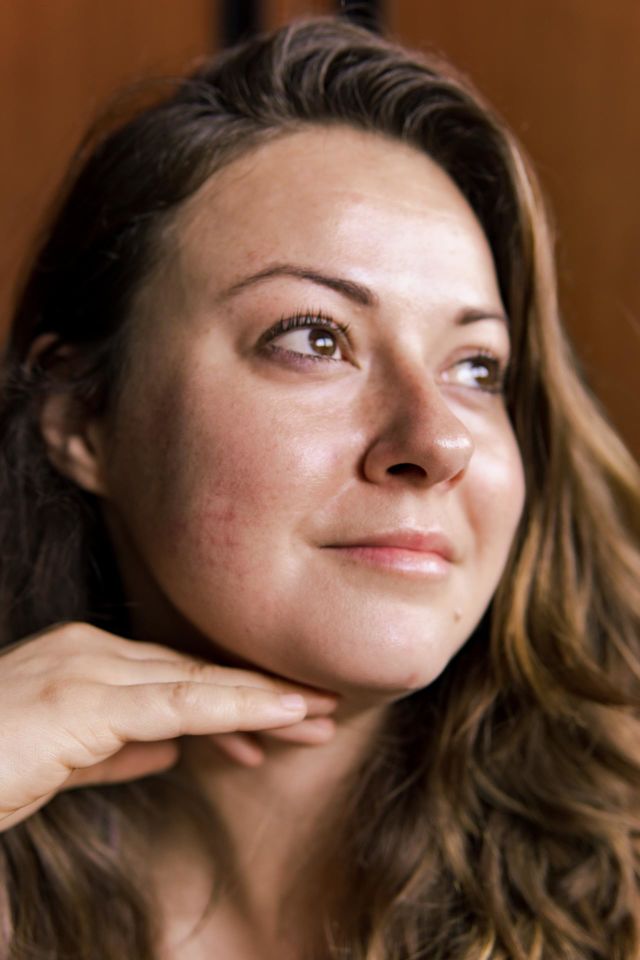 Moles, sun kissed freckles and mysterious red patches. This is how my skin expresses itself. 