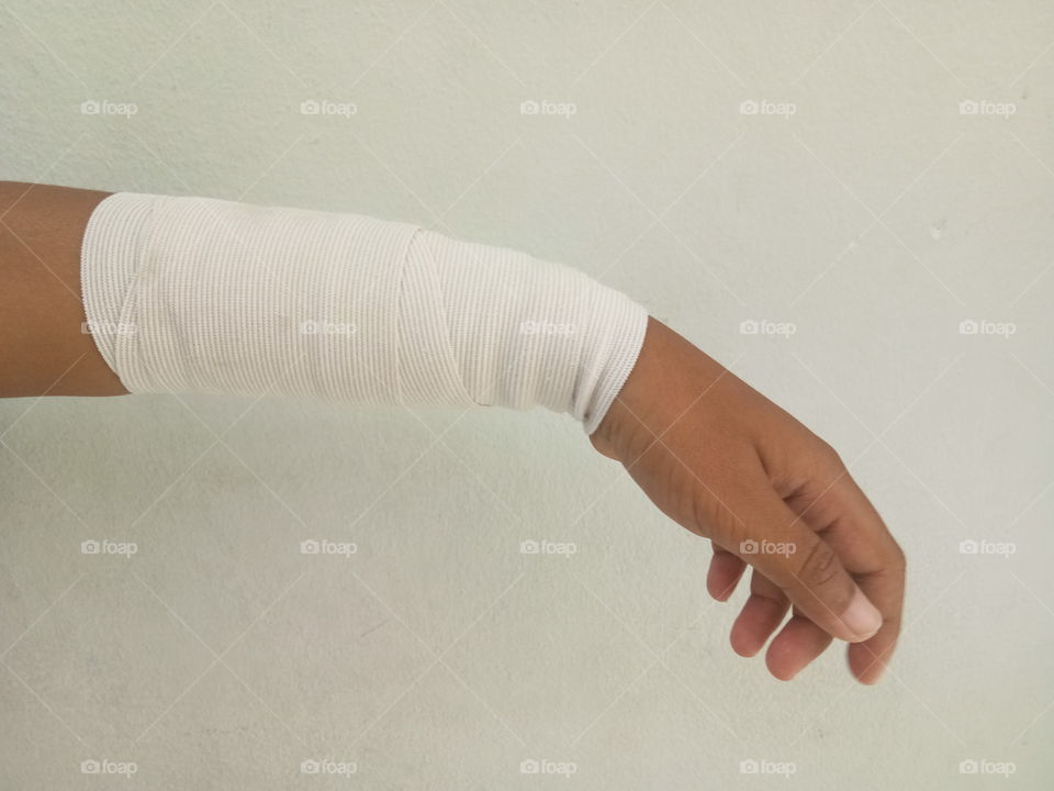broken arm