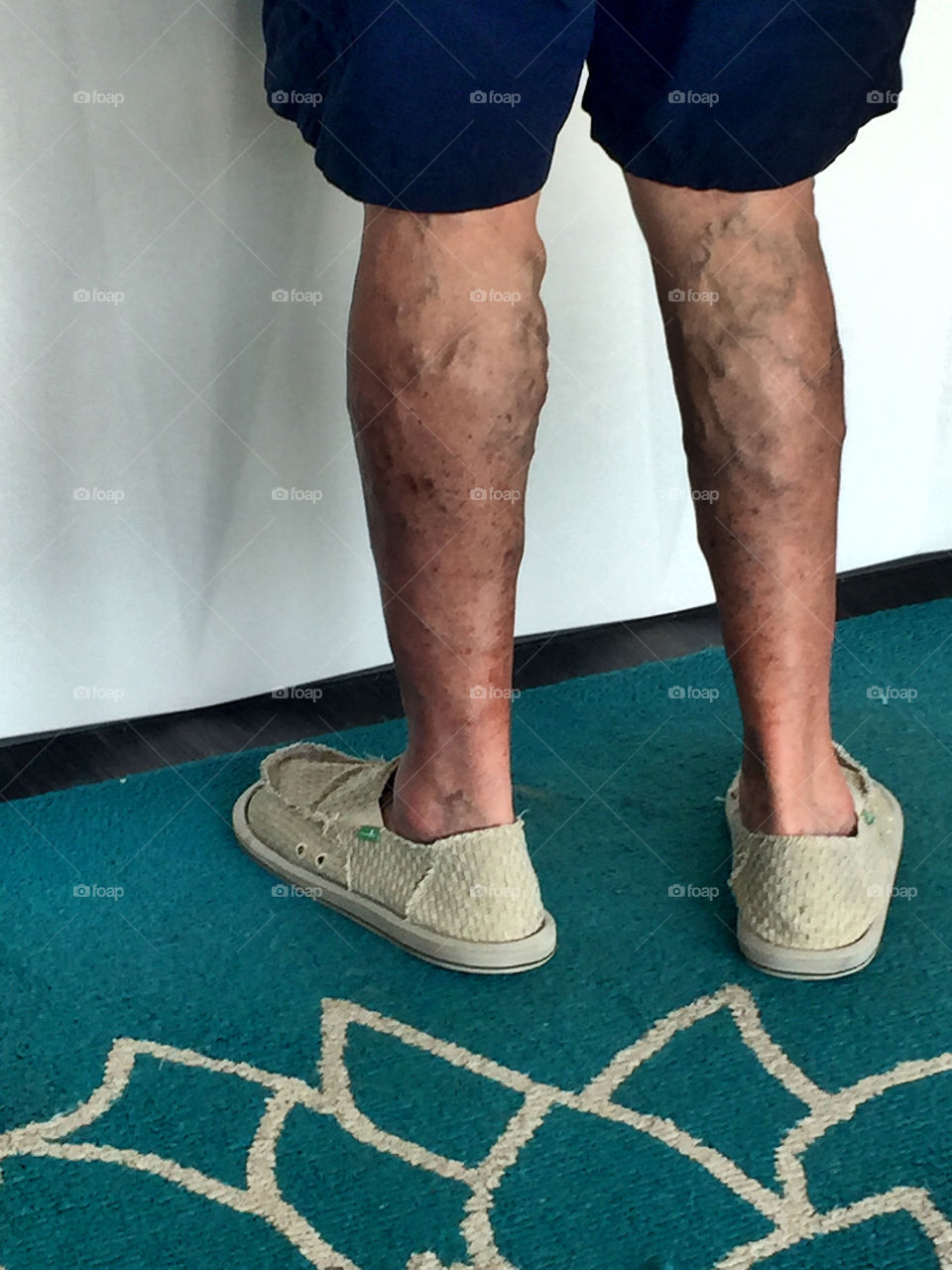 An elderly man's legs showing the effects of aging.