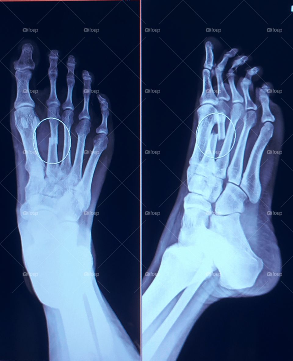 Foot Fracture Ap/lateral X-ray View shows Accidental injury