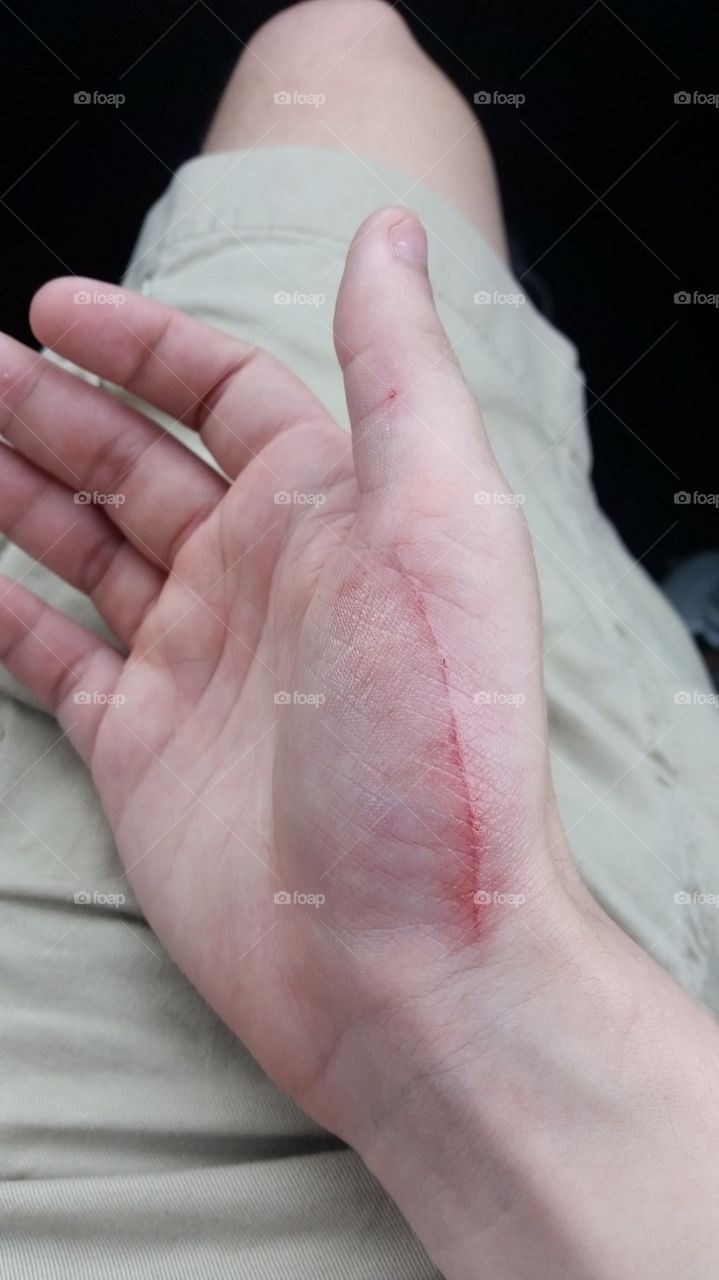 Hand with a cut