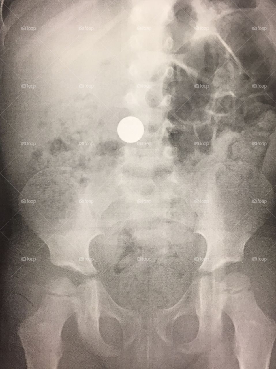 X-ray of a Metal Marble Ball Inside My Four-Year-Old
