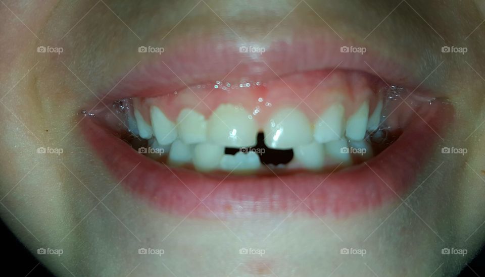closeup missing teeth