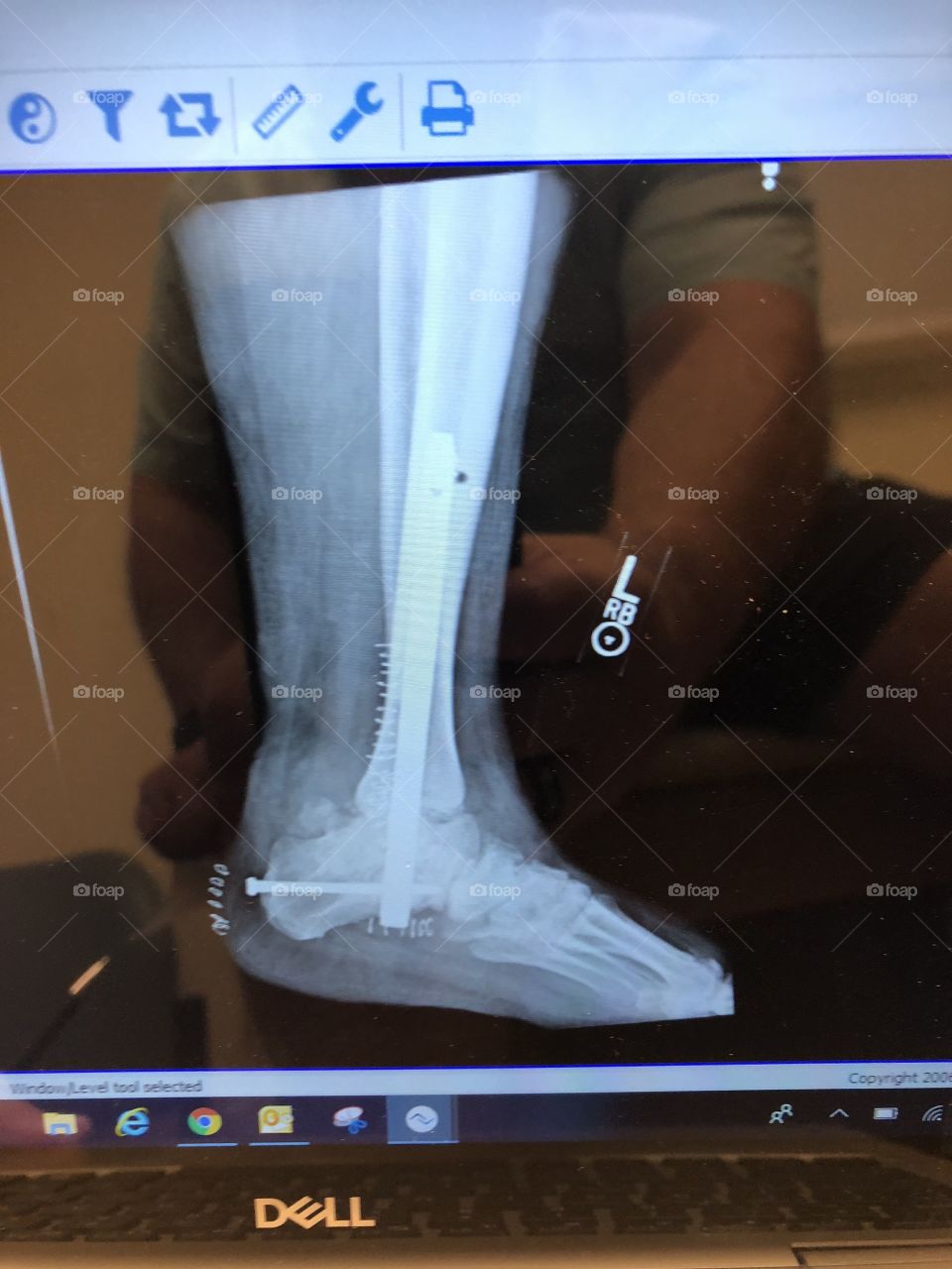X-ray of my leg after insertion of a titanium rod. Fibia was cut to remove bone that was ground up to fuse the ankle joint. 75 staples held four incisions closed. Notice the bolt in the heel to hold the rod in place. 