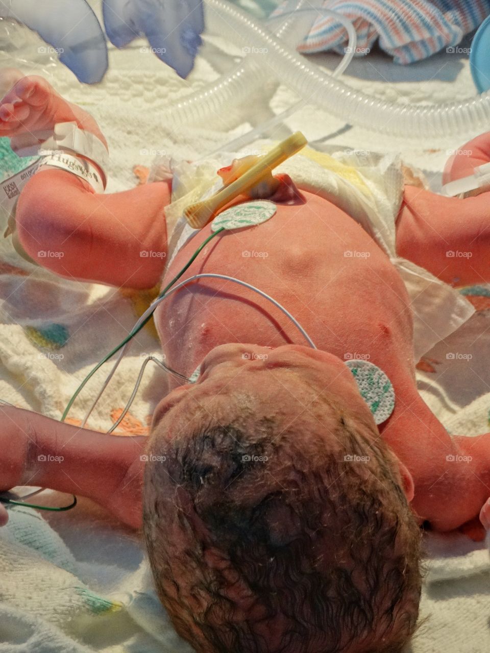 Newborn Infant In Intensive Care
