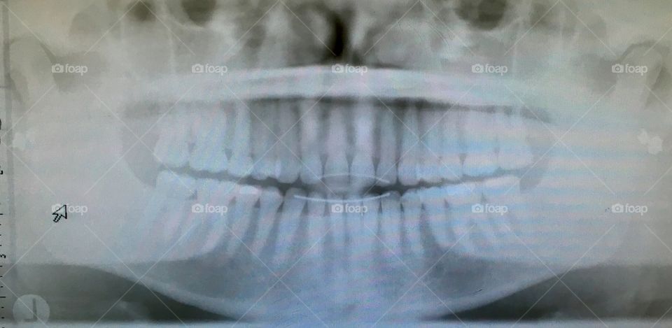 Panograph ...getting teeth straight