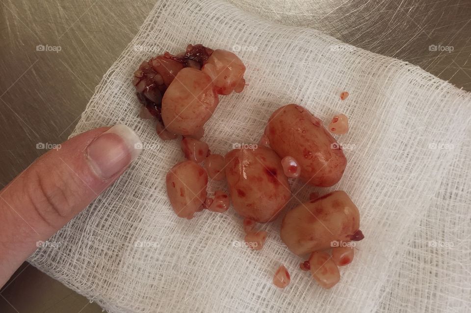 Bladder stones removed from a dog. 