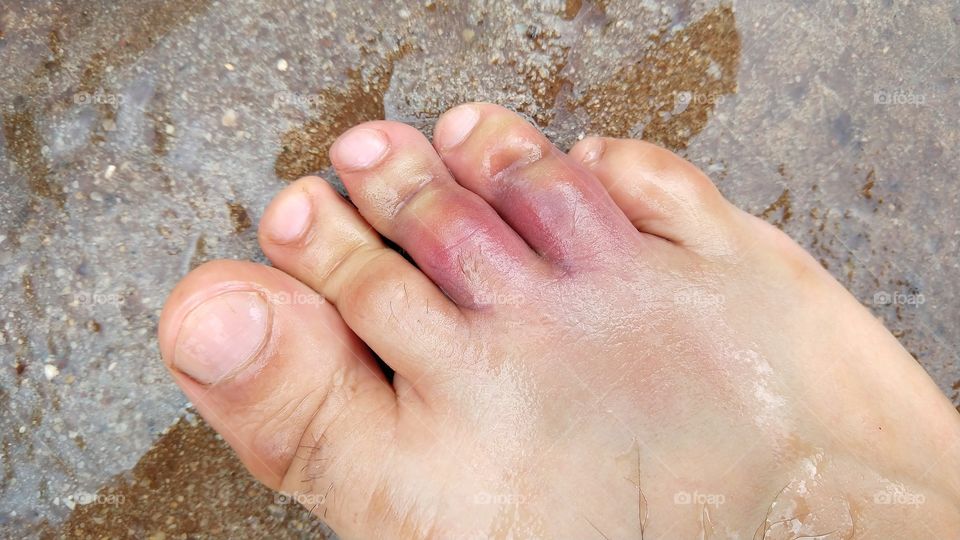 Pé com os dedos machucados.