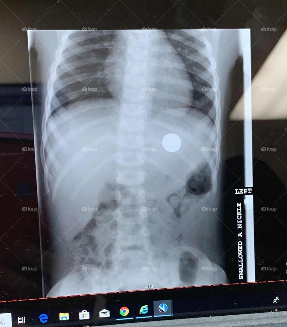 X-ray of a nickel inside a 3 year olds stomach. 
