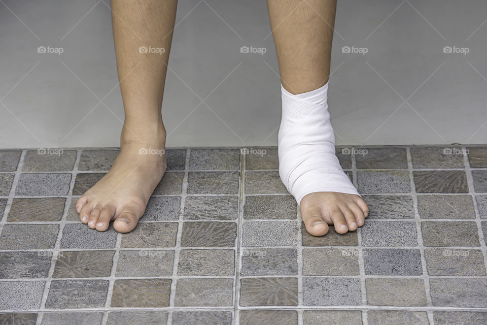 The  gauze bandages around the Ankle boy and leg swelling from inflammation.