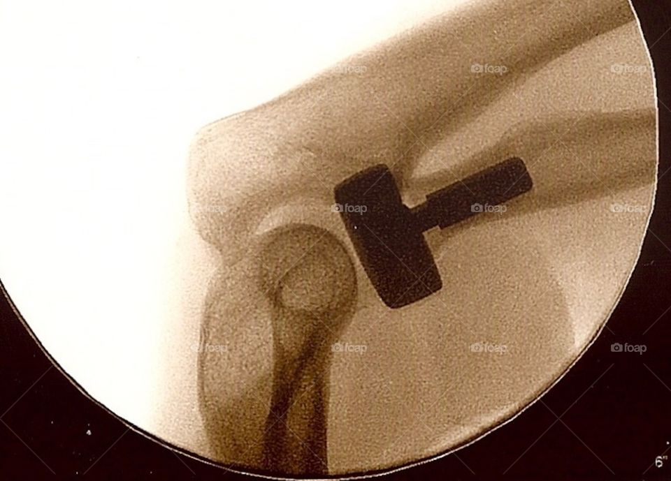 My new elbow 