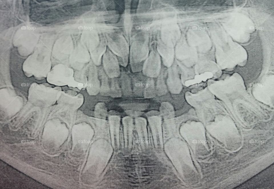 Dental X-Ray, child teeth x-ray