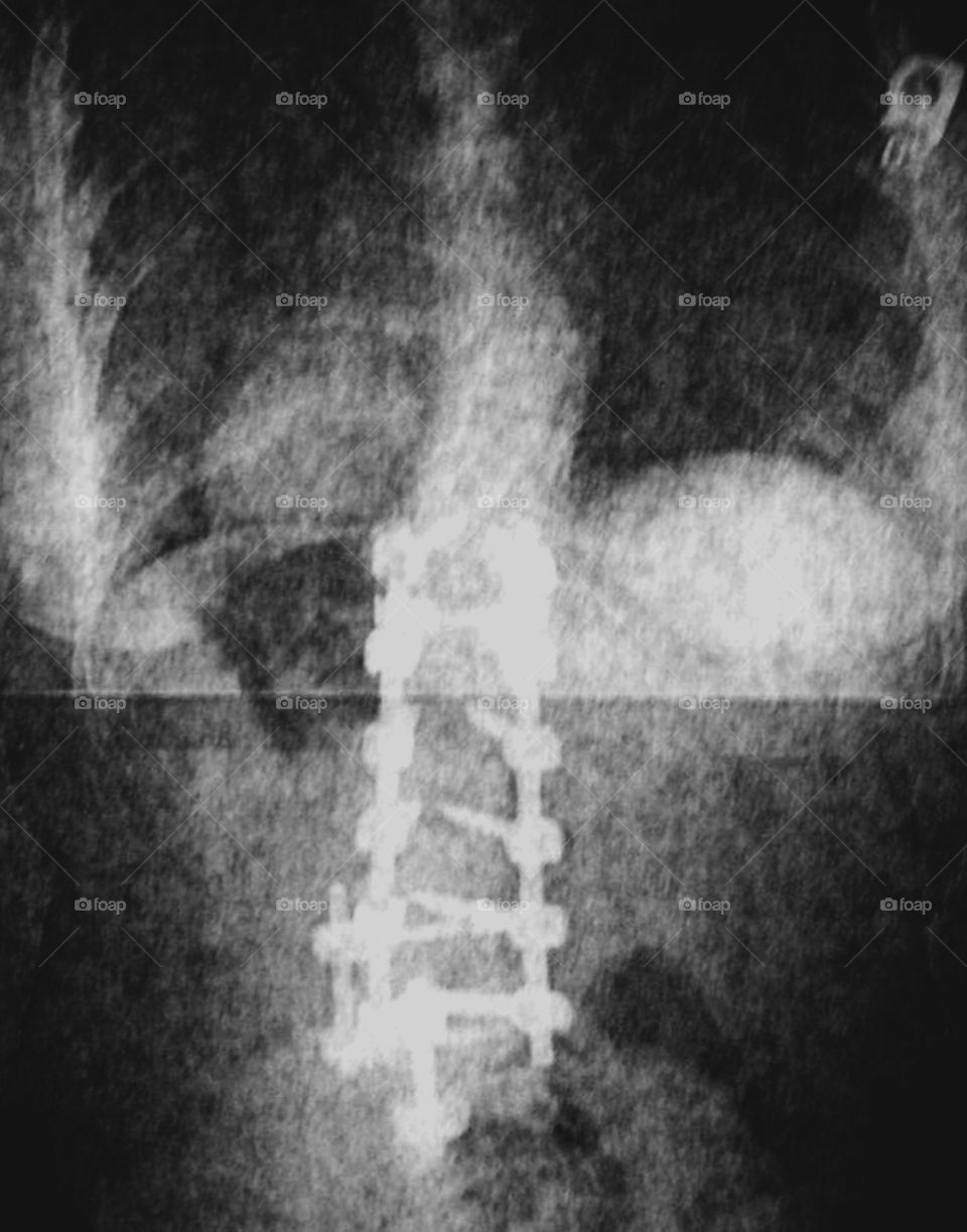 Scoliosis X-ray 