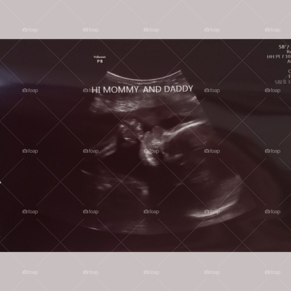 Ultrasound of Baby Sucking His Thumb