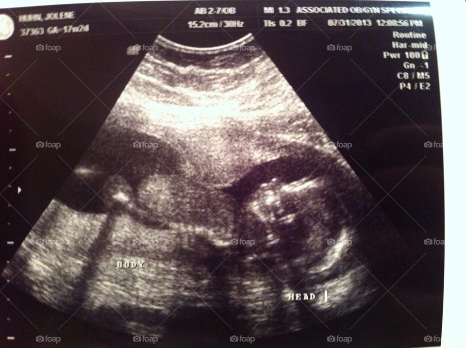 Baby Jeremy ultrasound 