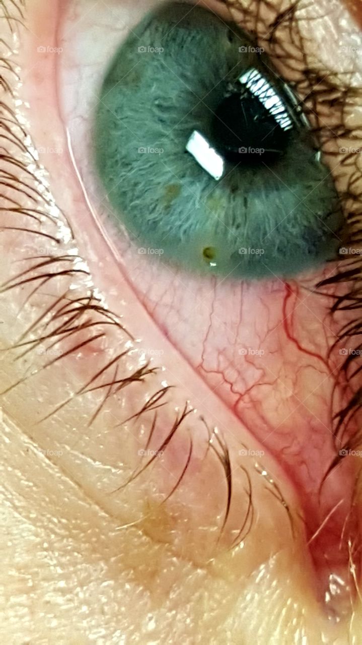 steel shot embedded in eye