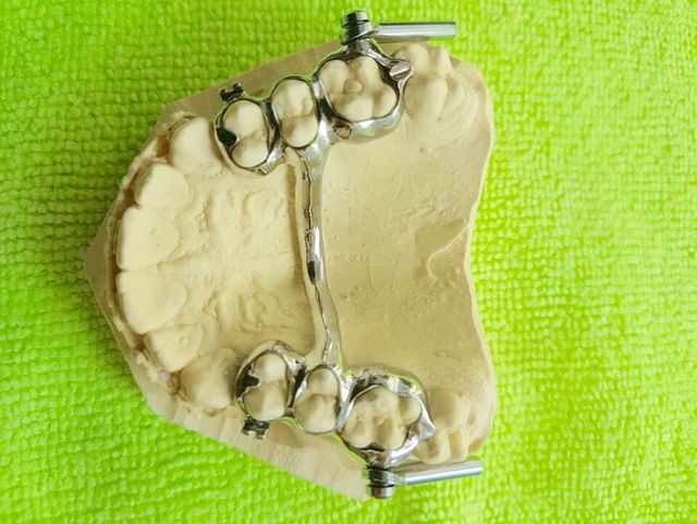 Dental prosthesis 