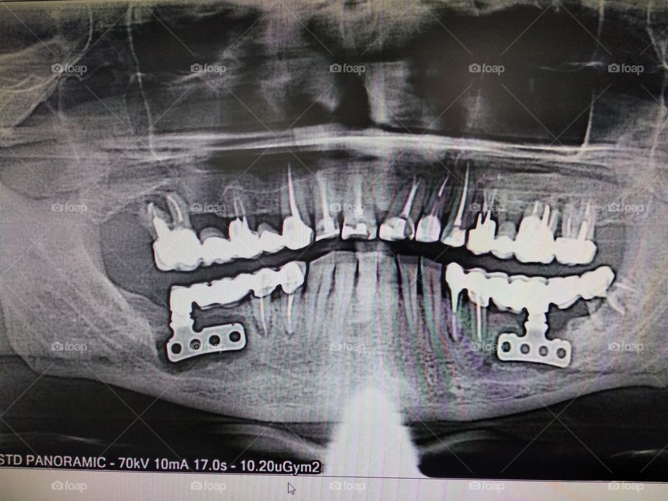 Dental renthenogramm with implantant
