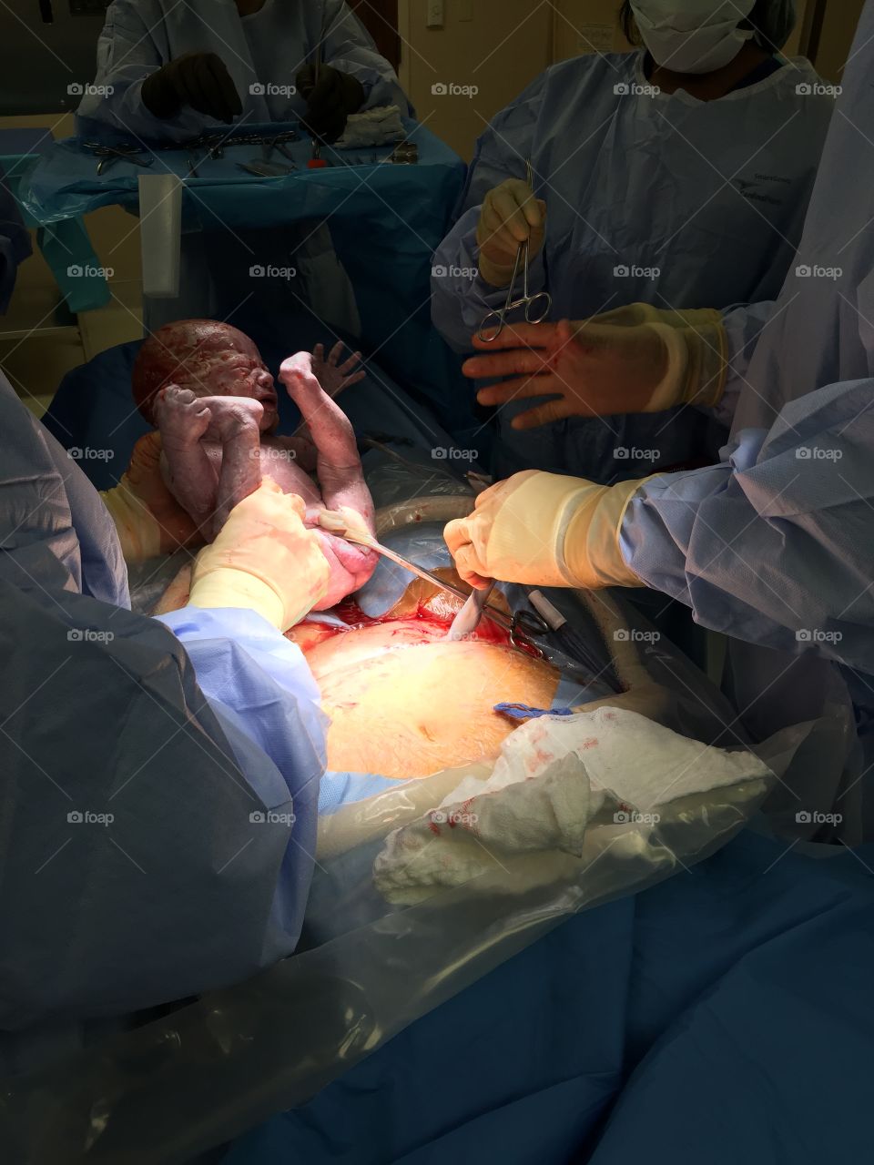 Birth. C section birth