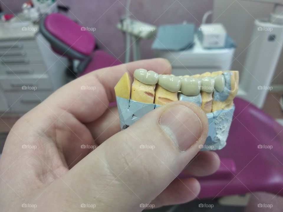 Ceramic dental Bridge on model