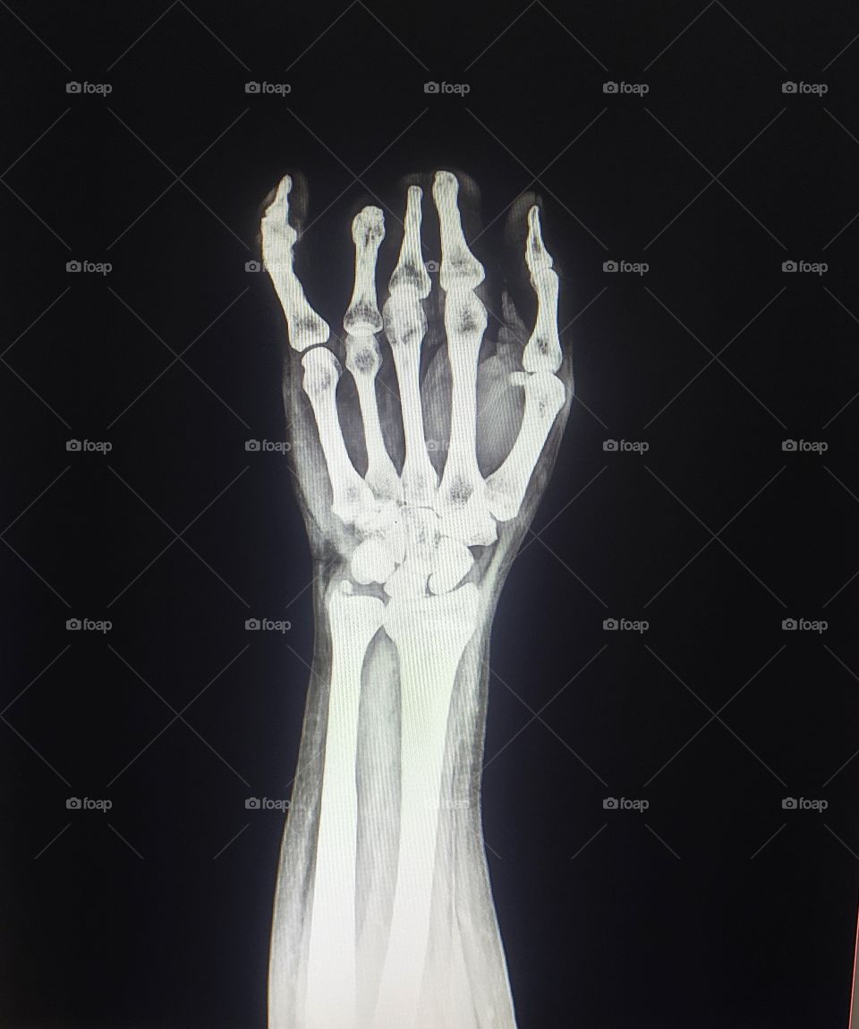 X-ray of Hand Ap view Shows Hand Crush injury in the industry