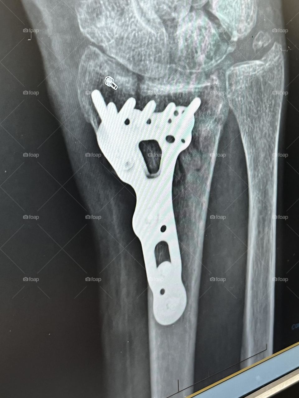 Distal Radial Hardware