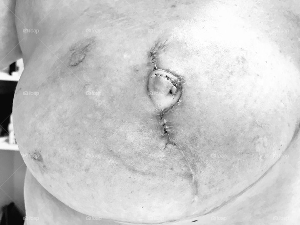 Nipple Reconstruction Journey 