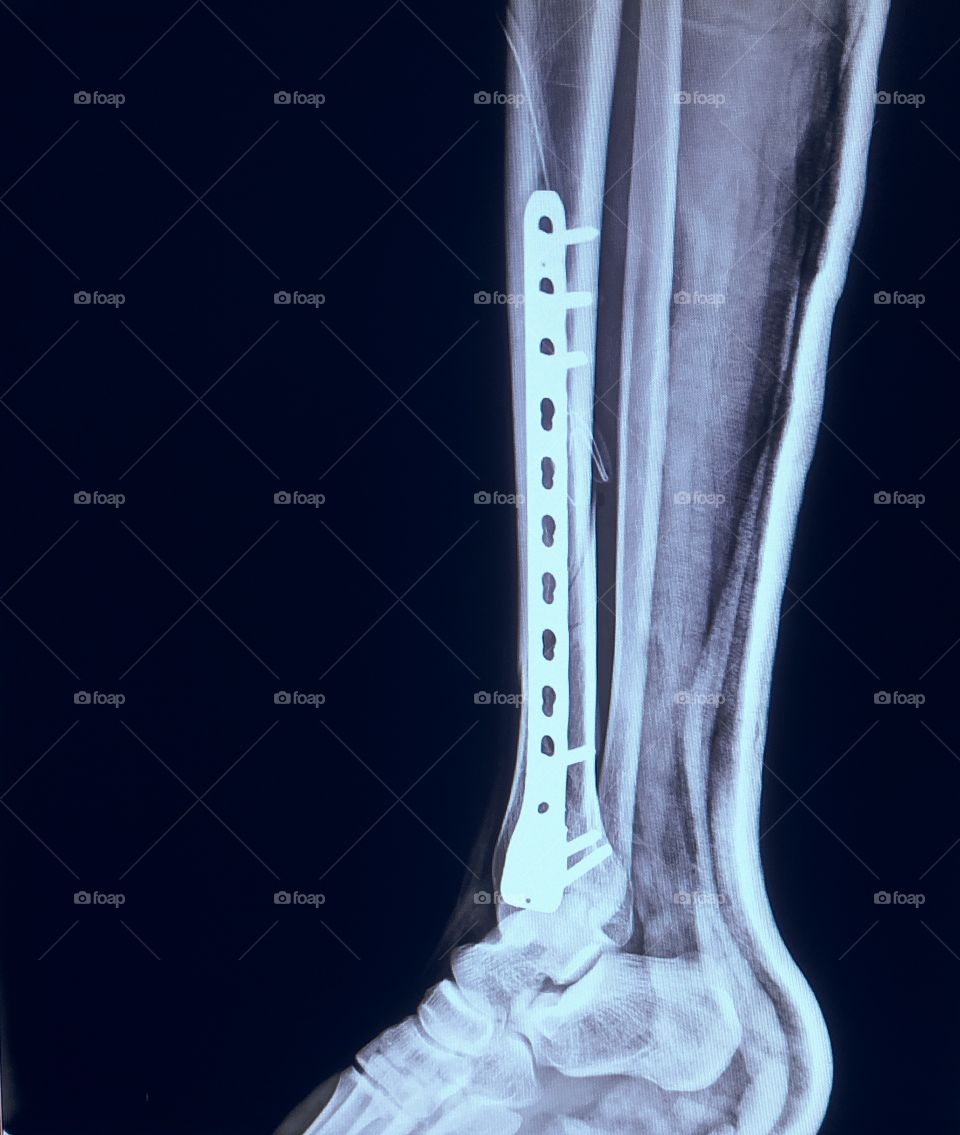 Fibula fracture Plating Post Operative Xray view