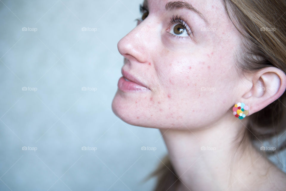 Close-up portrait of a young millennial woman with acne prone skin