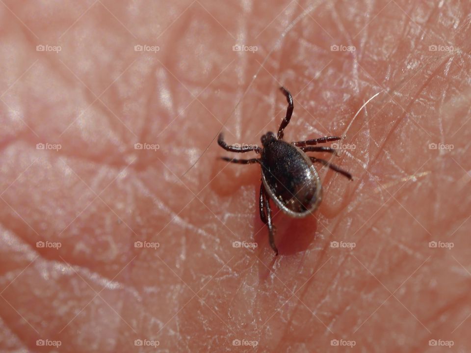 Tick crawling on human skin