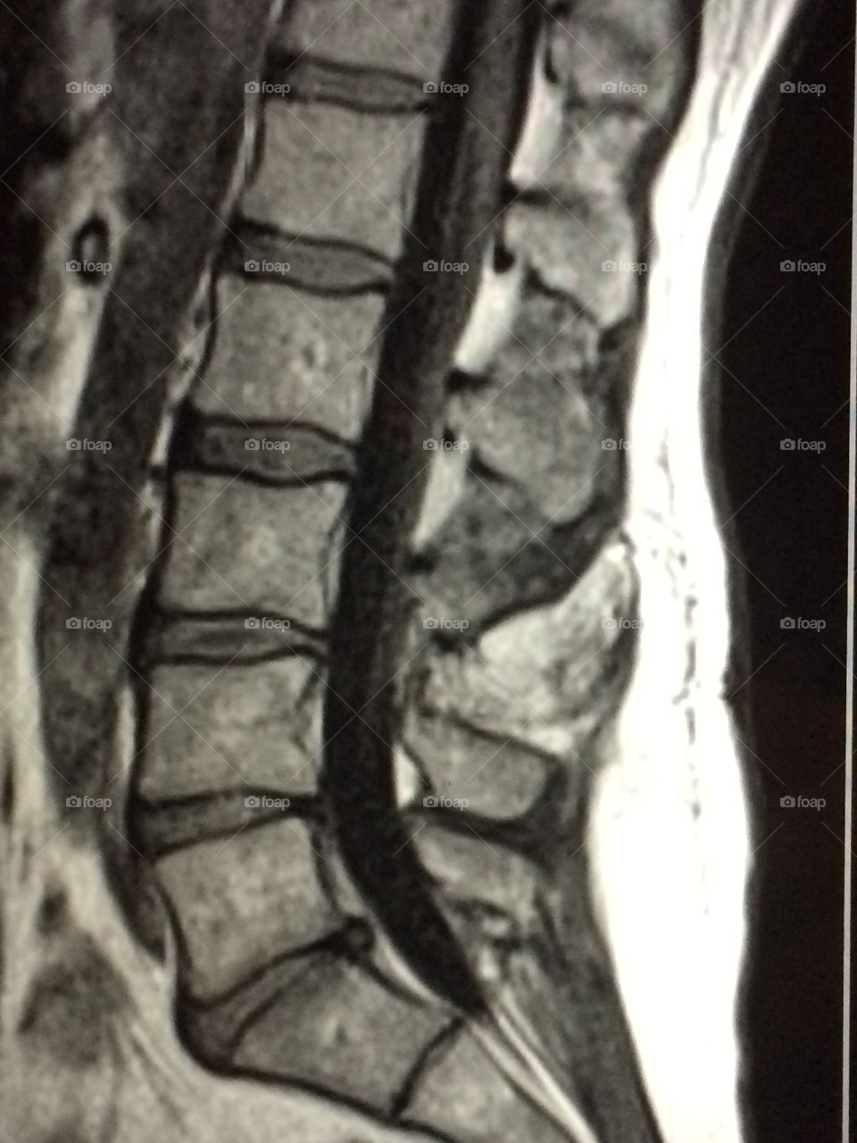 MRI of the Lumbar Spine with Disc Herniation