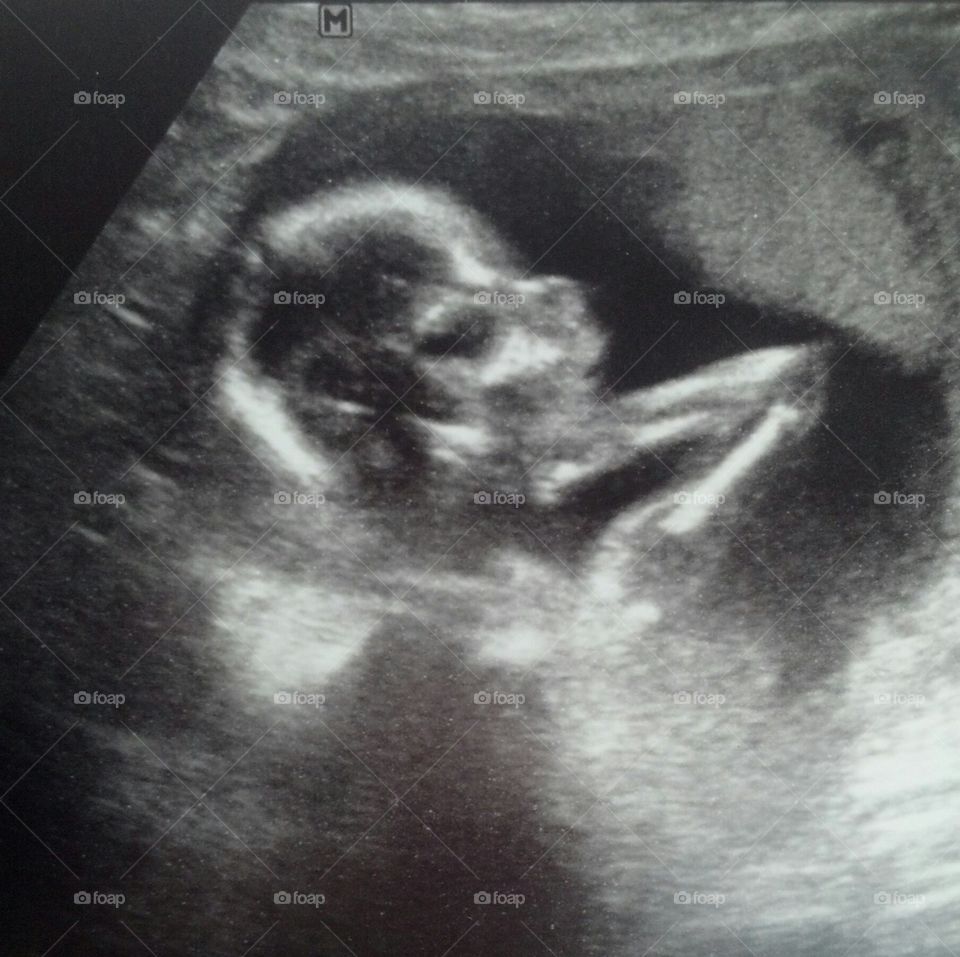 ultrasound showing my daughter's face and arm.